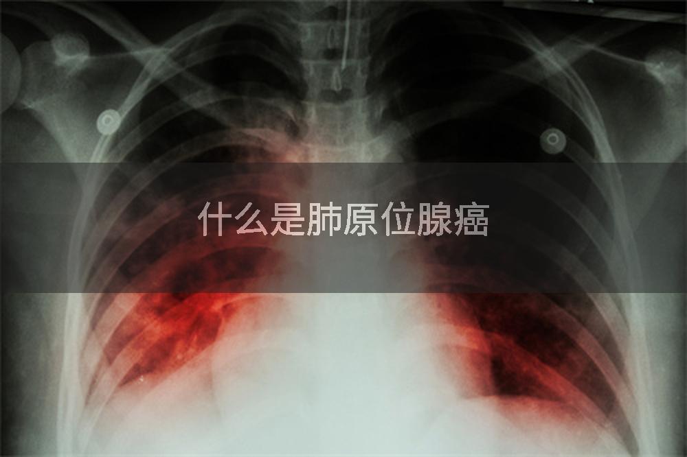 什么是肺原位腺癌