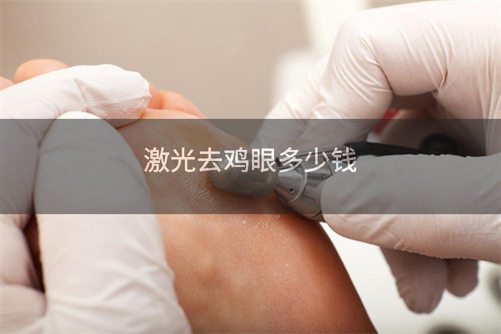 激光去鸡眼多少钱