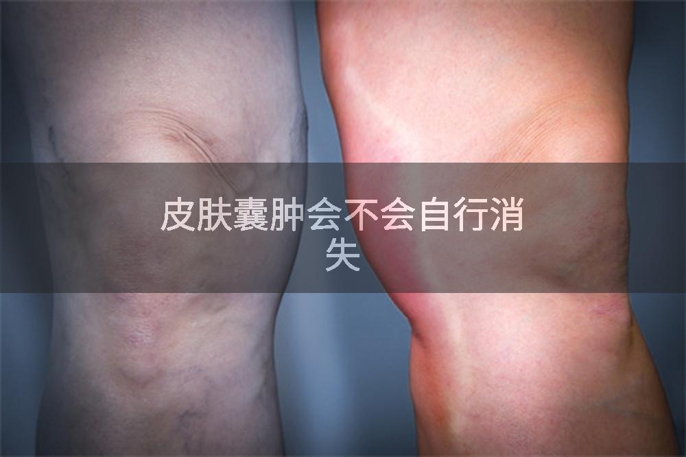 皮肤囊肿会不会自行消失