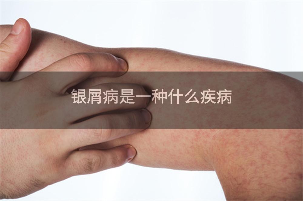 银屑病是一种什么疾病