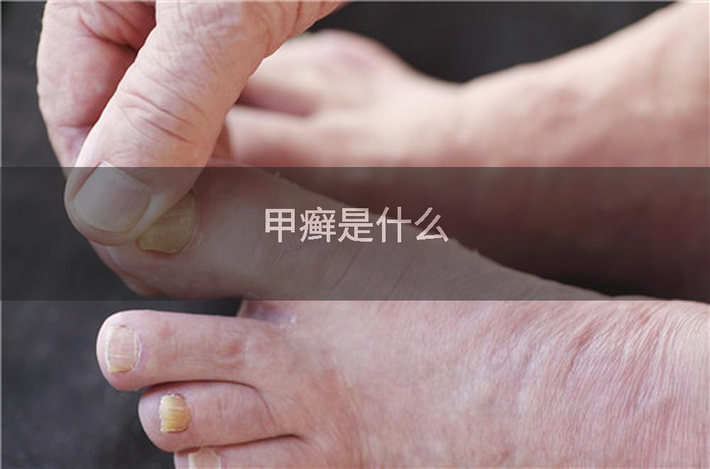 甲癣是什么
