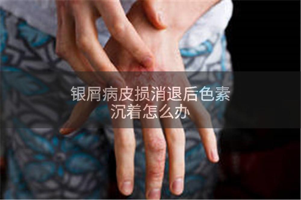 银屑病皮损消退后色素沉着怎么办