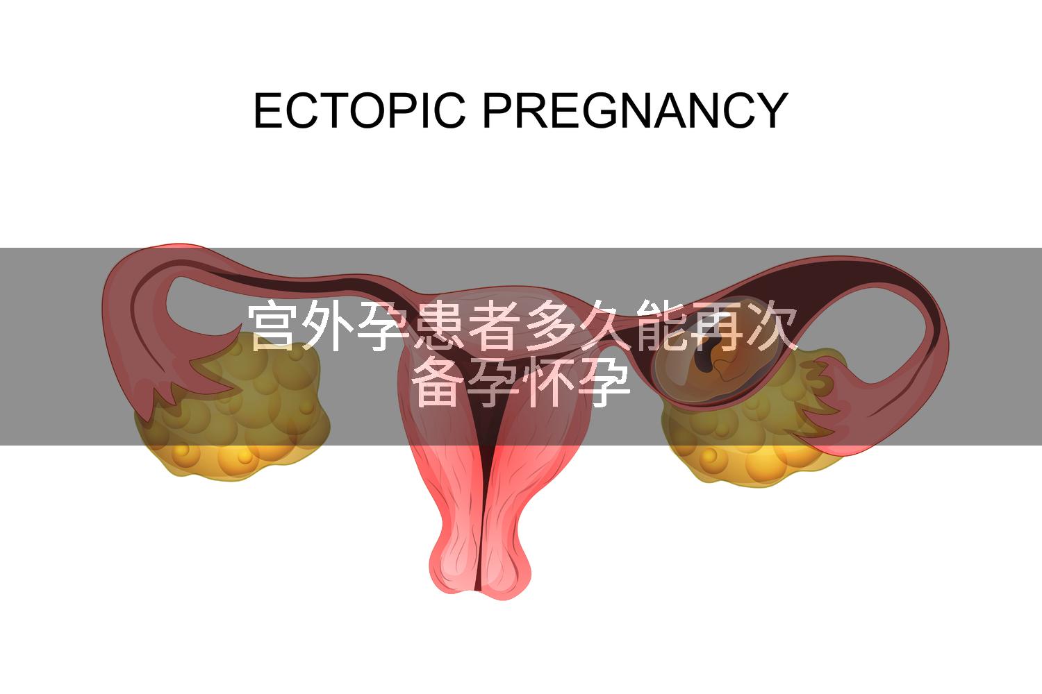 宫外孕患者多久能再次备孕怀孕