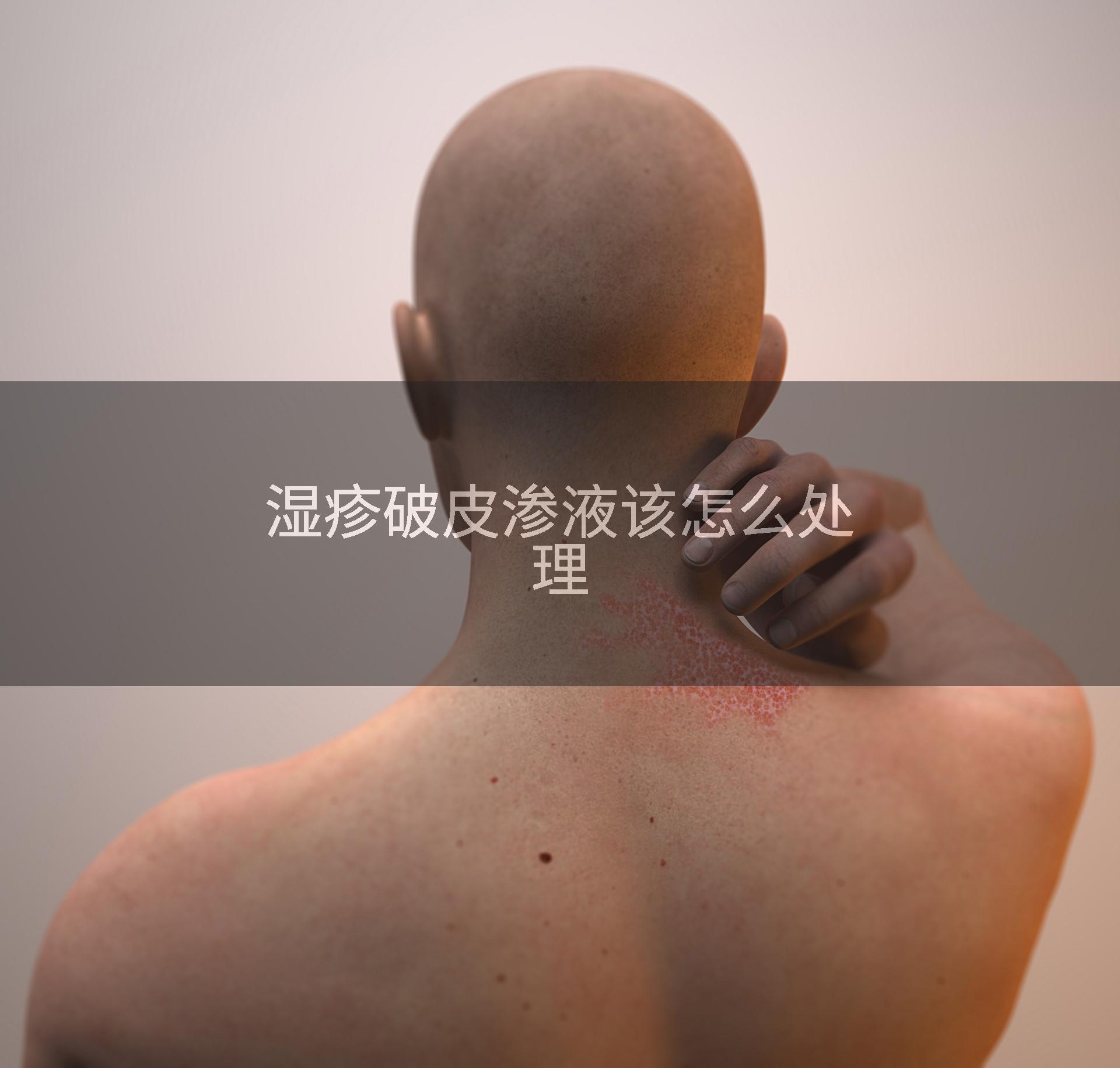 湿疹破皮渗液该怎么处理