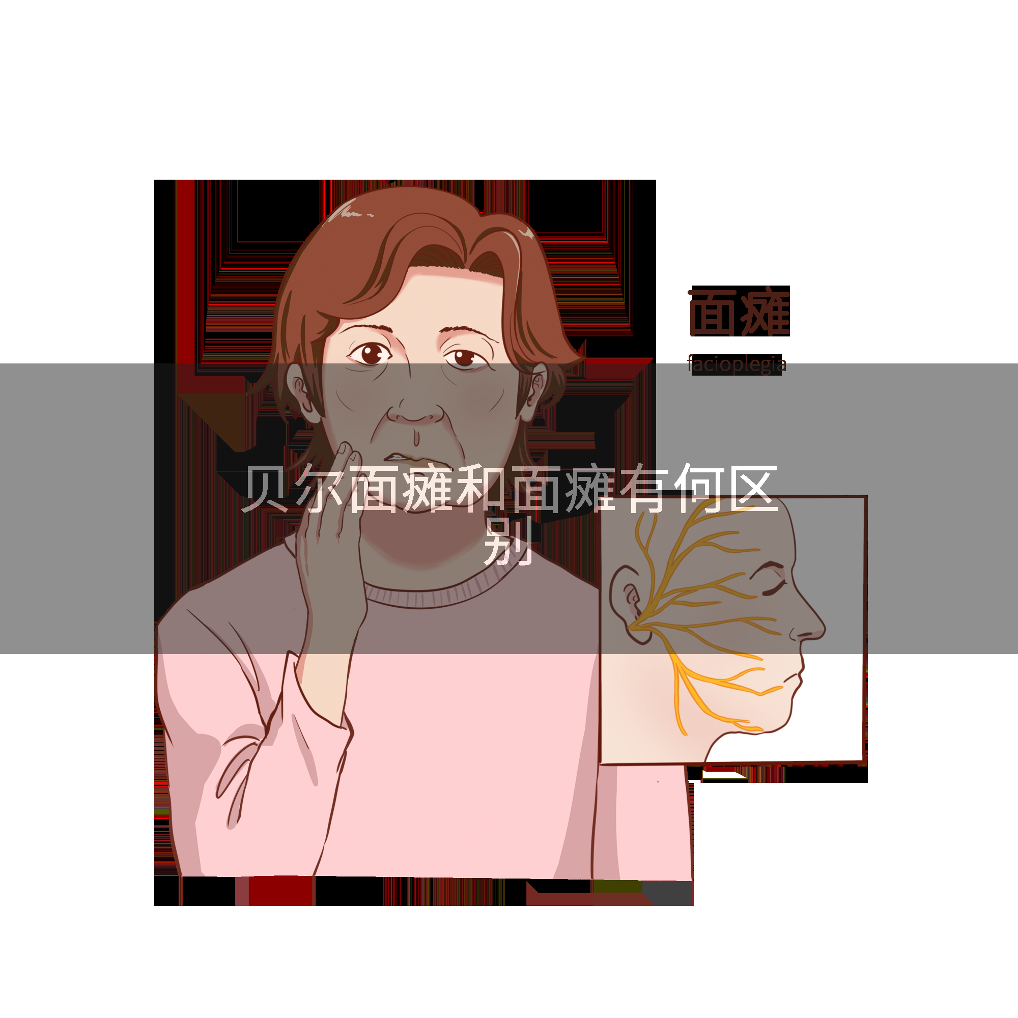 贝尔面瘫和面瘫有何区别