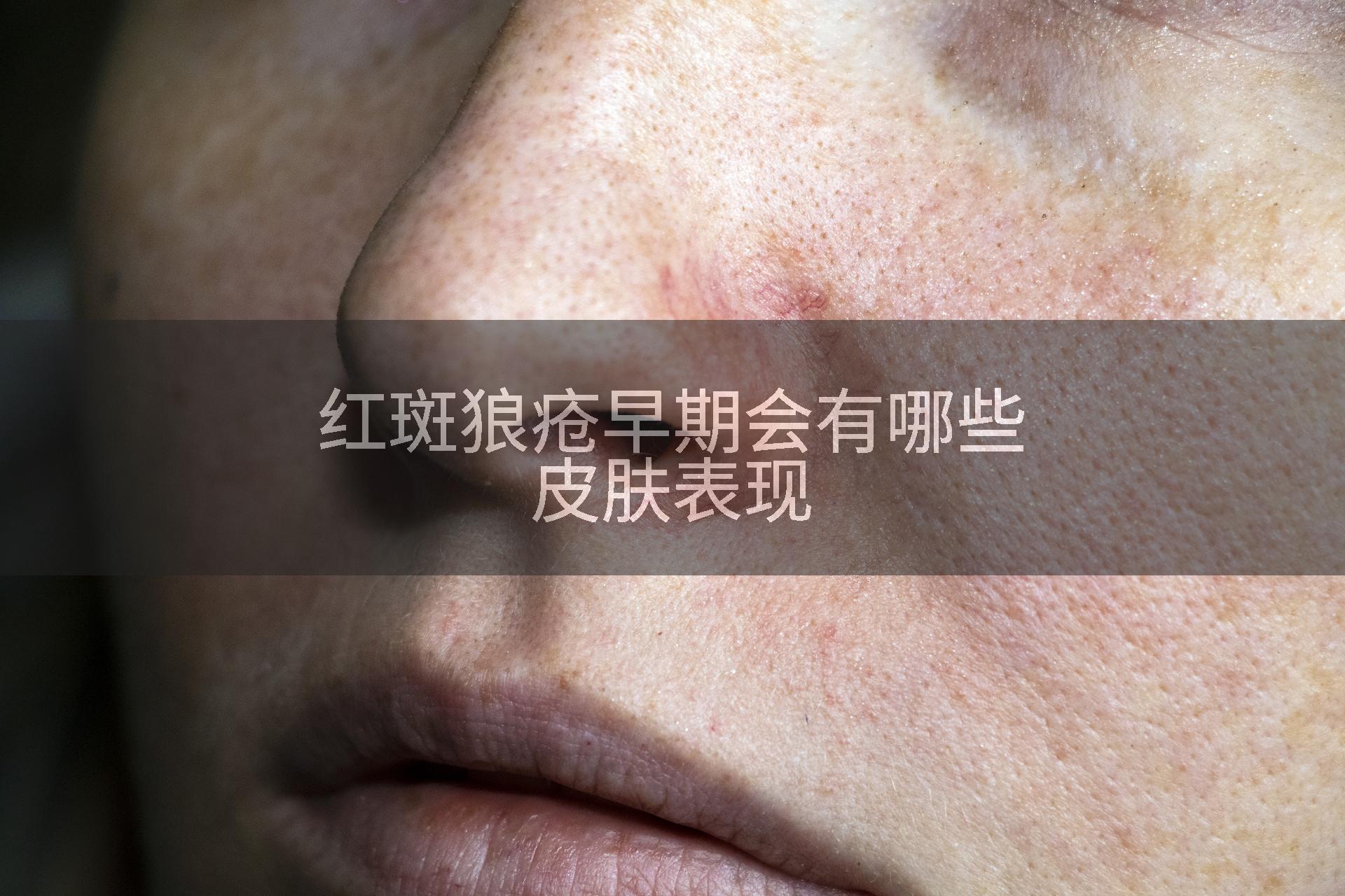 红斑狼疮早期会有哪些皮肤表现
