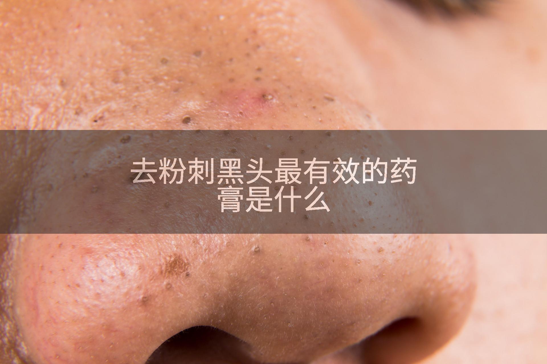 去粉刺黑头最有效的药膏是什么