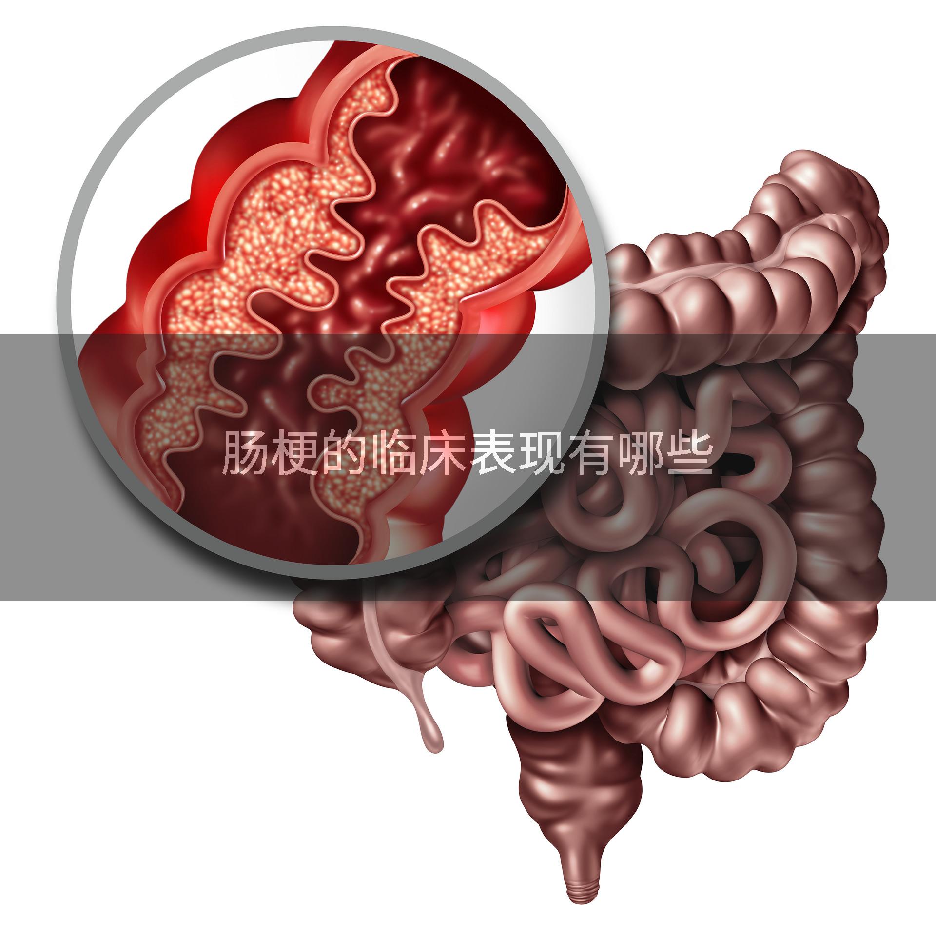 肠梗的临床表现有哪些