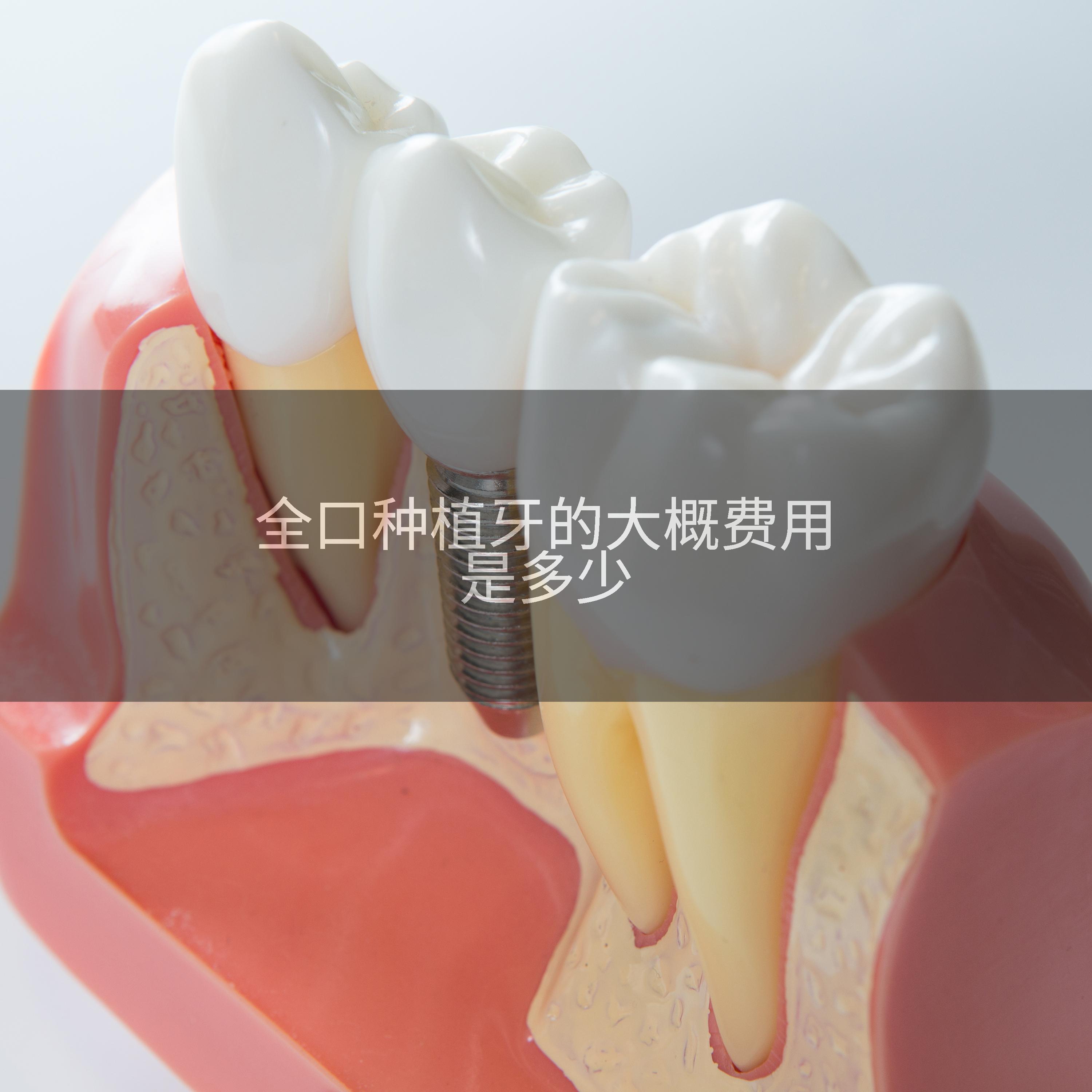 全口种植牙的大概费用是多少