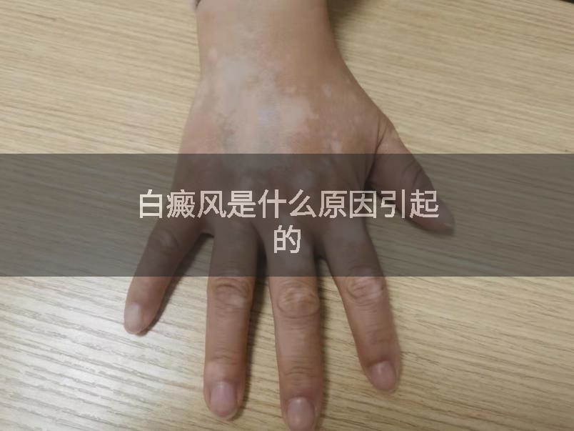 白癜风是什么原因引起的