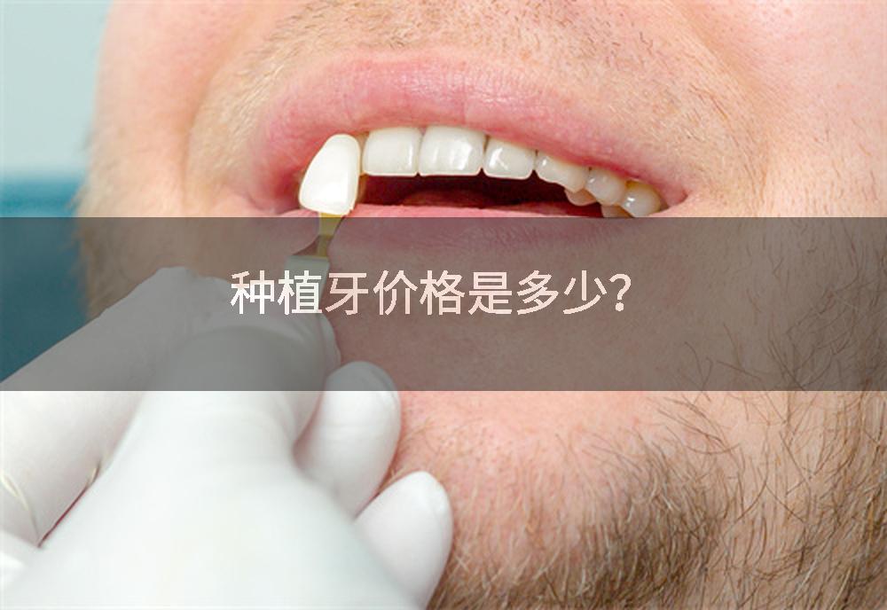 种植牙价格是多少？