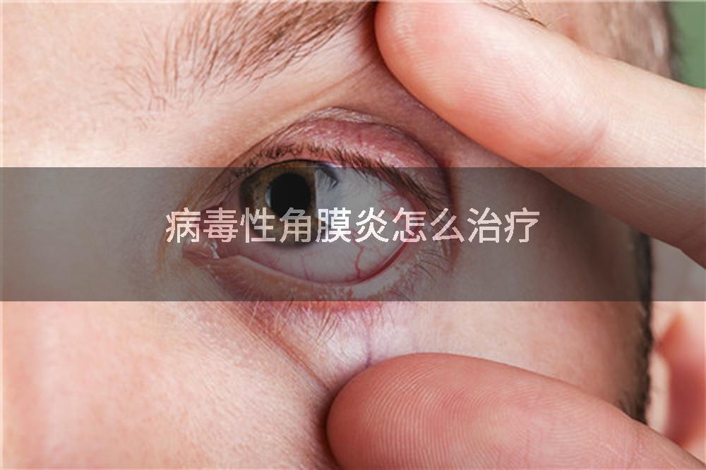 病毒性角膜炎怎么治疗